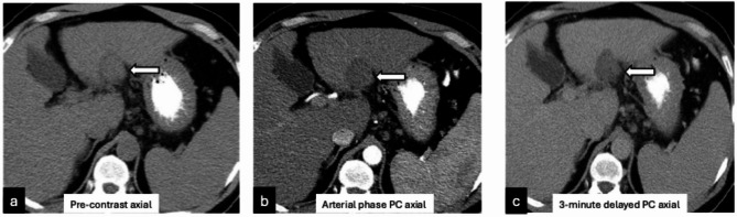 Accuracy of cross-sectional imaging in predicting tumor viability using the LI-RADS treatment response algorithm after image-guided percutaneous ablation with radiologic-pathologic explant correlation.