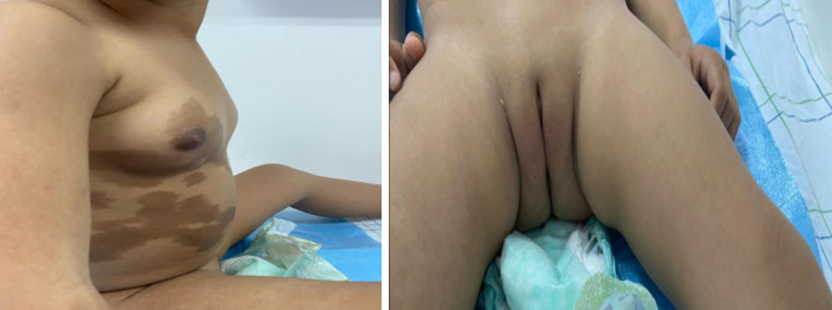 [Precocious puberty in the McCune-Albright Syndrome: a case report].
