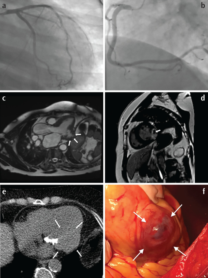 Is MINOCA Syndrome Causing Fatal Left Ventricular Aneurysms Less Innocent than It Appears?