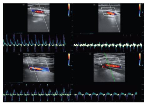 Non-invasive Monitor of Effective Chest Compressions with Carotid and Femoral Artery Ultrasound in the Emergency Department.