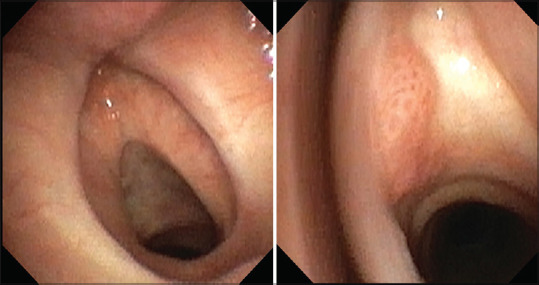 A 34-year-old man with chest pain and lung cyst.
