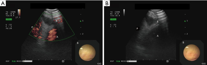Complications of linear endobronchial ultrasound guided biopsies: narrative review.