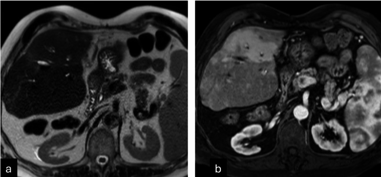 Accuracy of cross-sectional imaging in predicting tumor viability using the LI-RADS treatment response algorithm after image-guided percutaneous ablation with radiologic-pathologic explant correlation.
