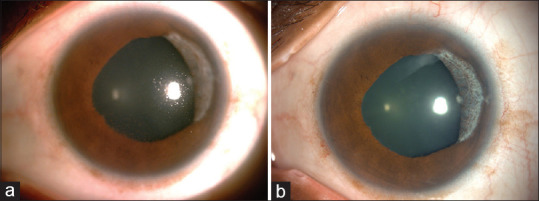 Polymerase chain reaction in viral anterior uveitis with secondary glaucoma: Analysis of 28 eyes from a tertiary eye care center in South India.