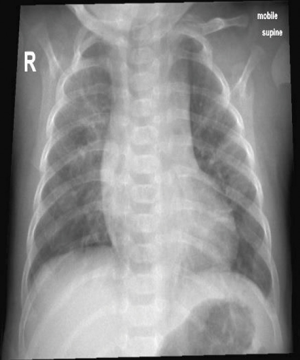 Diaphragmatic Paralysis Following Chest Tube Insertion in an Infant: <i>Case report and literature review</i>.