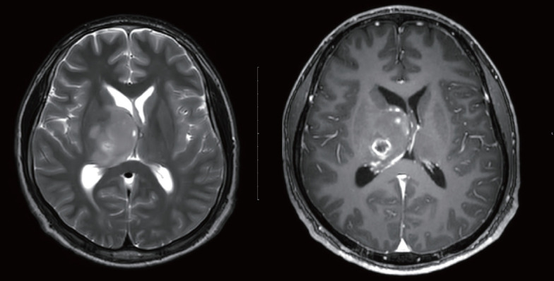 Lifelong Management of Neurofibromatosis 1 Patients.
