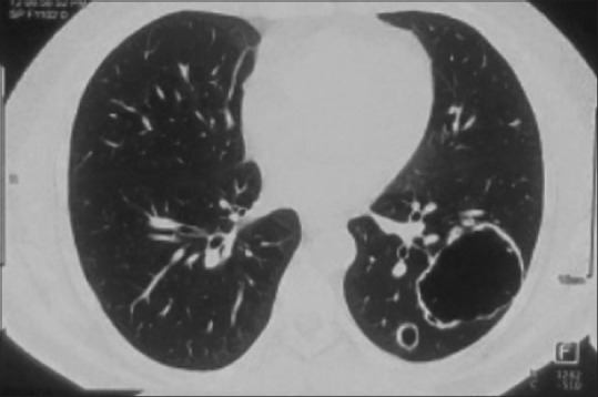 A 34-year-old man with chest pain and lung cyst.