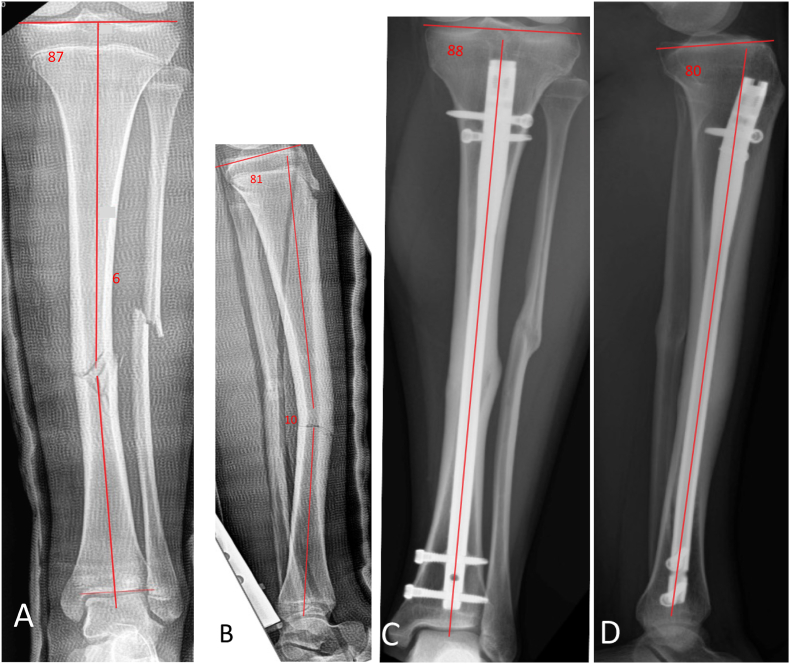 Outcomes of Suprapatellar Intramedullary Nail Fixation of Tibial Shaft Fractures in Skeletally Immature Patients.