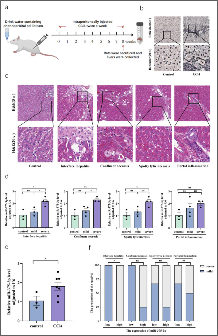 Downregulated Expression of Serum Exosome-Derived miR-375-3p Alleviates Interface Hepatitis and Promotes Fibrosis Regression in Patients With Chronic Hepatitis B.