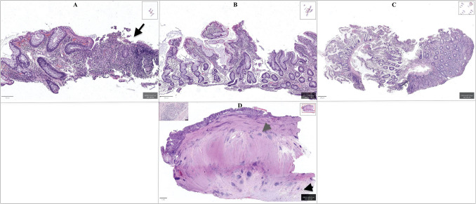 Genetic Mutations and Small Bowel Ulcerating Disease: Role in Diagnosis?