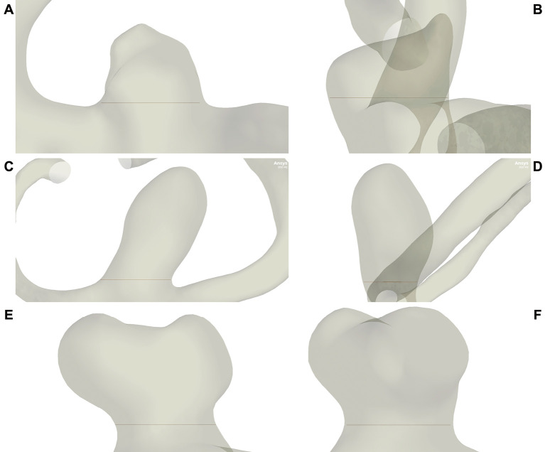 Comparison of ELAPSS Score and Computational Fluid Dynamics for Predicting Growth of Small Unruptured Cerebral Aneurysms.