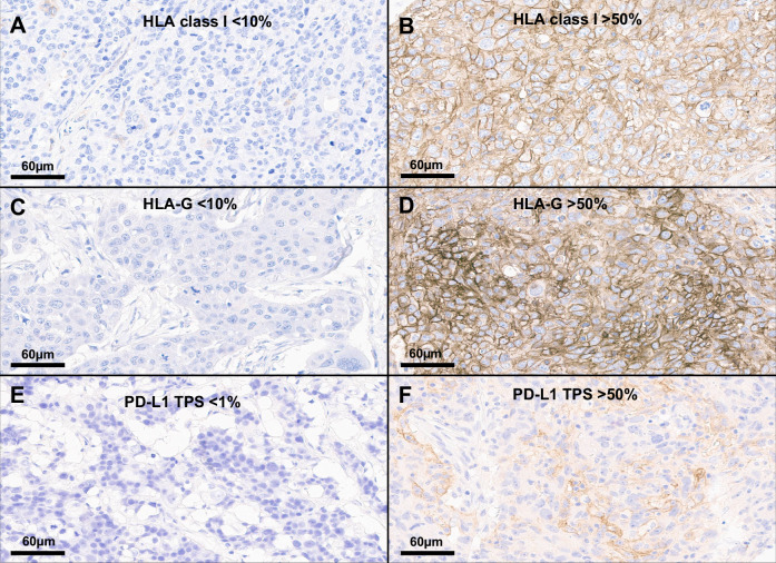 Effects of pregnancy on breast cancer immunology: immune biomarker and TIL quantification.