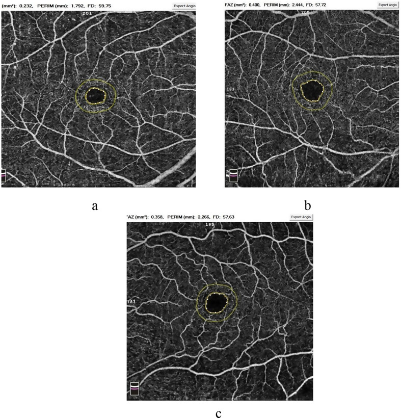 Assessment of retinal microvascular changes in patients with systemic lupus erythematosus using optical coherence tomography angiography.