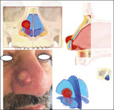 Margins in head and neck non-melanoma skin cancer surgery: clinical/pathological criteria and their impact on oncological outcomes and therapeutic choices. A systematic review.