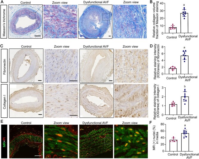 Mineralocorticoid receptor antagonism attenuates arteriovenous fistula stenosis by modulating the phenotype of vascular smooth muscle cells.