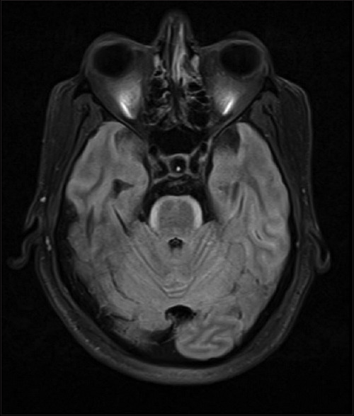 "Bloomy Rind on Cheese Sign" - A Radiological Biomarker of Leptomeningeal Metastasis.