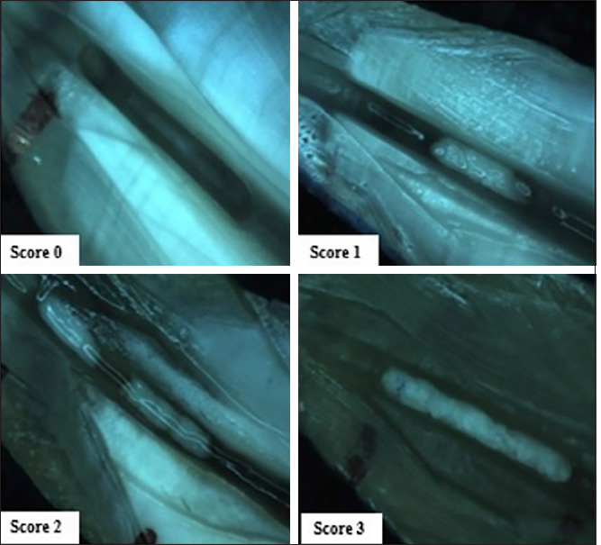 Cleaning Effectiveness of QMix and EDTA When Activated with Different Techniques: An In Vitro Study.