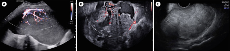 Malignant germ cells tumor of the ovary.