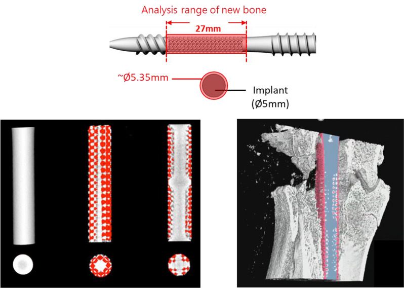 Biomechanical design considerations of a 3D-printed tibiotalocalcaneal nail for ankle joint fusion.