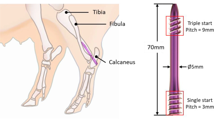 Biomechanical design considerations of a 3D-printed tibiotalocalcaneal nail for ankle joint fusion.