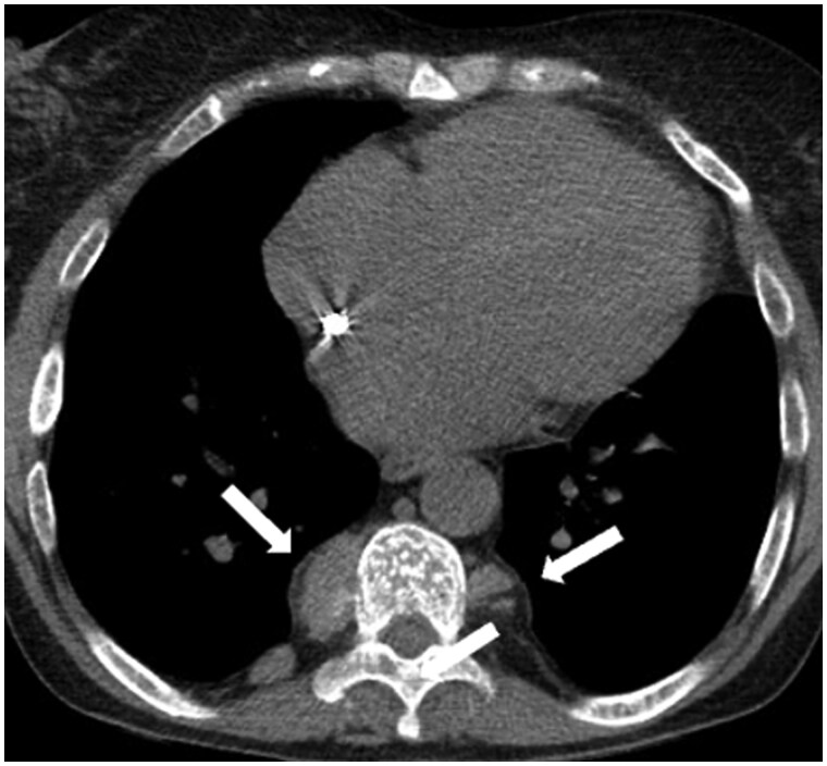 A diagnostic approach to mediastinal masses in clinical practice.