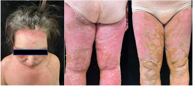 Generalized Pustular Psoriasis During Early Pregnancy Successfully Treated with Spesolimab: A Case Report.