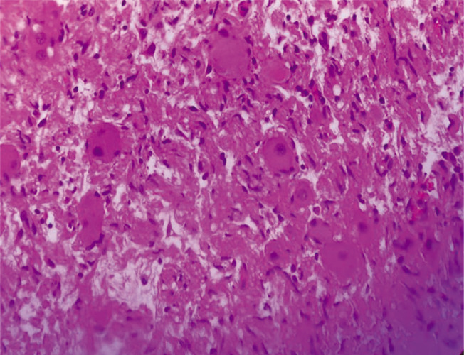 ROHHAD-NET Syndrome: A Case Series.
