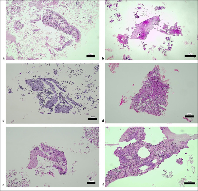 Diagnostic utility of cell block preparations from liquid-based cytology in cervical lesions: A comparative retrospective analysis.