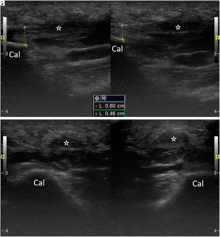 Plantar Fibromatosis/Fascitis in Ankylosing Spondylitis: Why/Where to Inject?