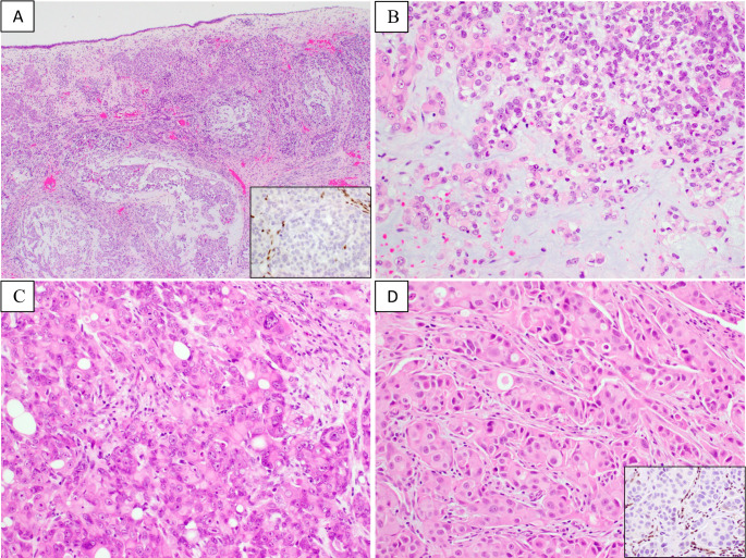 Clinicopathologic and Molecular Characterization of SMARCB1-Deificient Sinonasal Carcinomas -A Systematic Study from a Single Institution Cohort.