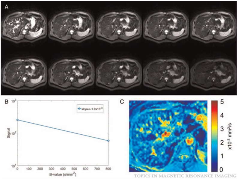 Current Update on DWI-MRI and Its Radiomics in Liver Fibrosis-A Review of the Literature.