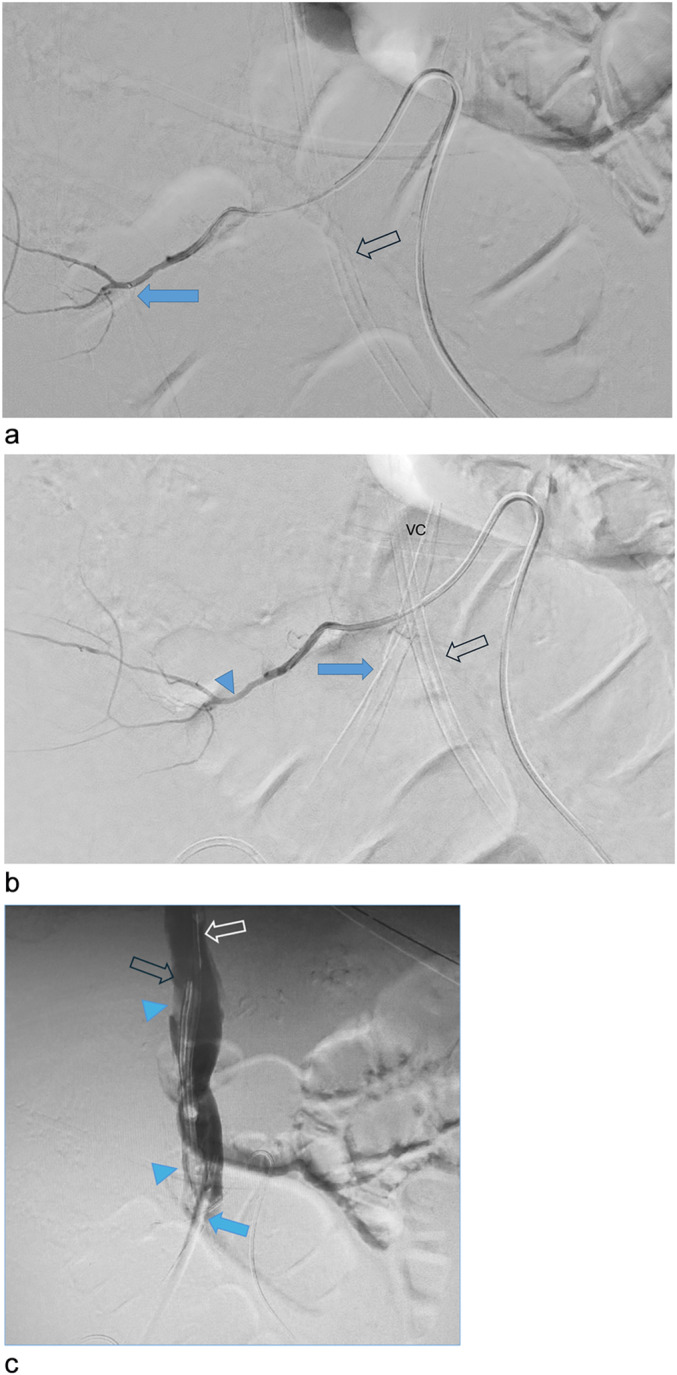From Venous to Arterial Blood in the Same Tunneled Dialysis Catheter After Starting a Continuous Renal Replacement Therapy: A Case Report.