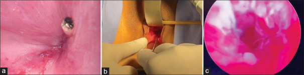 Restore the Continuity of Uterus-Cervix-Vagina for Cervical Restenosis after Cervicovaginal Reconstruction: A Case Report.