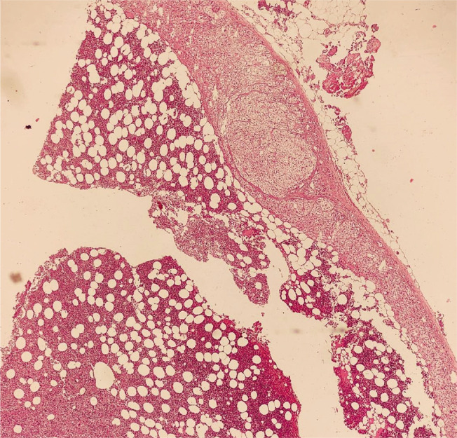 A Rare Case of Catecholamine-Secreting Adrenal Myelolipoma.