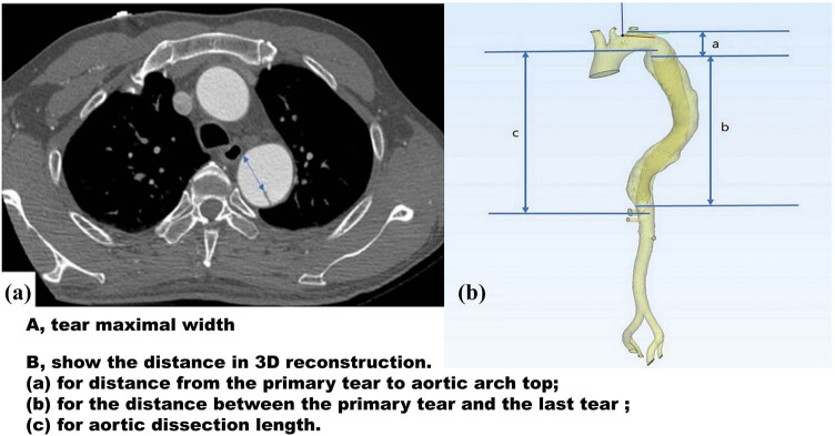Influencing factors of false lumen thrombosis in type B aortic dissection: A single-center retrospective study.