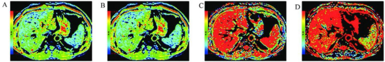 Current Update on DWI-MRI and Its Radiomics in Liver Fibrosis-A Review of the Literature.