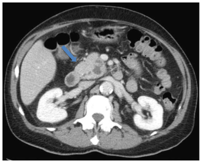 A Budding Pancreatic Mass: A Review of Disseminated Blastomycosis.