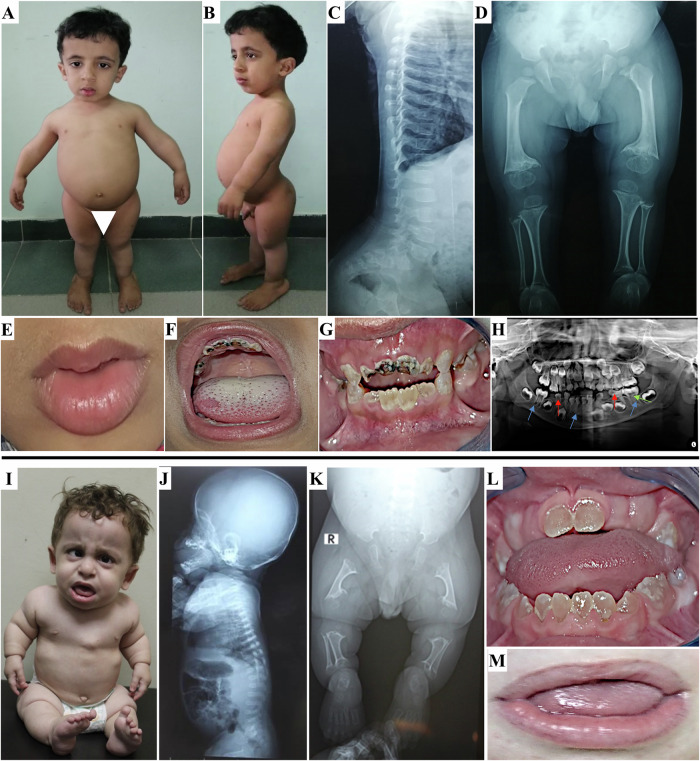 Deciphering the phenotypic spectrum associated with MIA3-related odontochondrodysplasia.