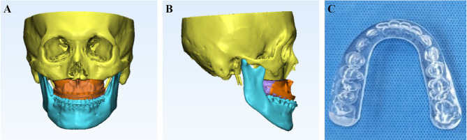 Comparison of manual and virtual model surgery for wafer fabrication in maxillary repositioning: an in vitro study.