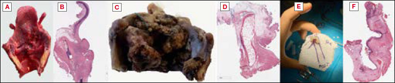 The impact of histology and molecular biology in refining the prognostic value of surgical margins in head and neck oncology - A narrative review.