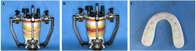 Comparison of manual and virtual model surgery for wafer fabrication in maxillary repositioning: an in vitro study.