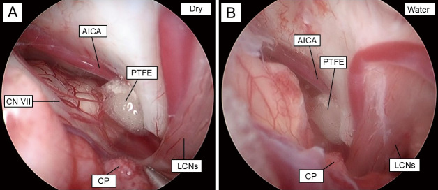 Comparison of Surgical Outcomes in Microscopic and Fully Endoscopic Microvascular Decompression for Hemifacial Spasm.