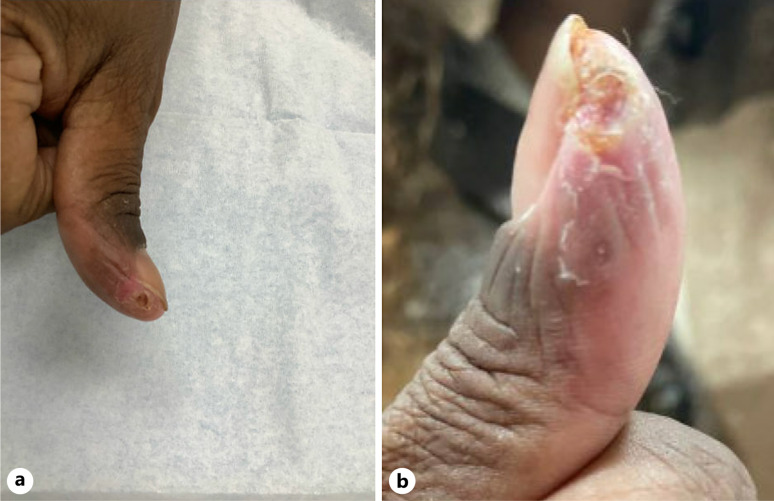 Management of Resistant Herpetic Whitlow: A Case of Recurrent Herpetic Whitlow Resistant to Standard Therapy.