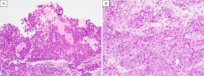 Clinicopathologic and Molecular Characterization of SMARCB1-Deificient Sinonasal Carcinomas -A Systematic Study from a Single Institution Cohort.