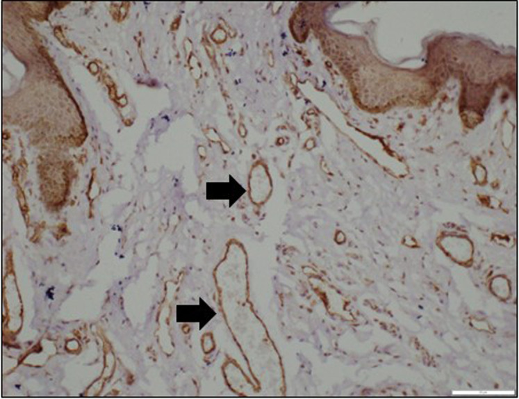 Comparison of Microvessel Density and Growth Factor Levels Between Inner and Outer Prepuce in Distal Hypospadias.