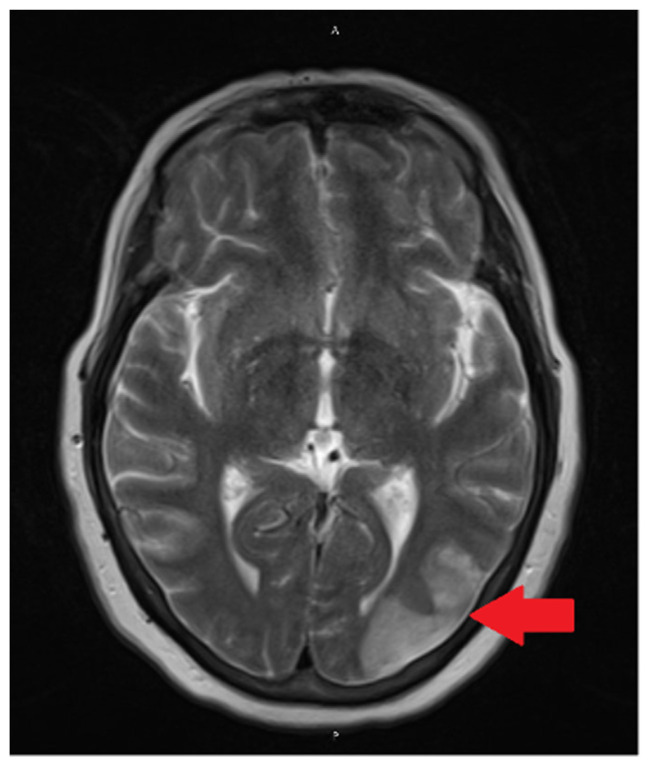 Reversible Cerebral Vasoconstriction Syndrome Induced by Sumatriptan: A Case Report and Review of Literature.