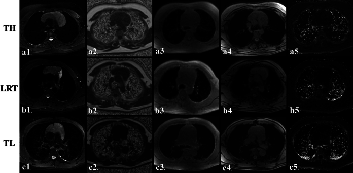 IDEAL-IQ Magnetic Resonance Imaging Fat Fraction Quantification in Distinguishing Thymic Hyperplasia From Low-Risk Thymoma and Thymic Lymphoma in Adulthood: A Reliability and Efficacy Analysis.