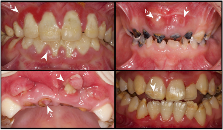 Oral and Heart Health: The Urgent Call for Early Dental Referrals.