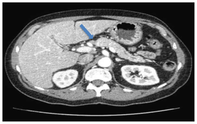 A Budding Pancreatic Mass: A Review of Disseminated Blastomycosis.