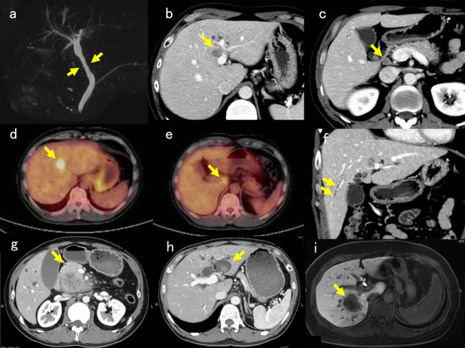 Subsequent development of cholangiocarcinoma caused by exposure to 1,2-dichloropropane and/or dichloromethane in the printing company in Osaka, Japan.